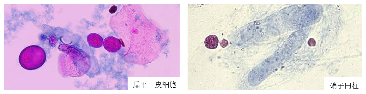 扁平上皮細胞/硝子円柱