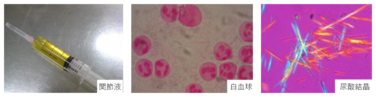 扁平上皮細胞/硝子円柱