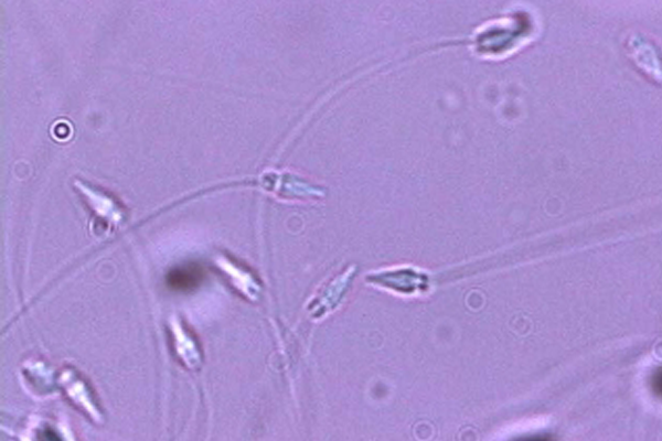 扁平上皮細胞/硝子円柱